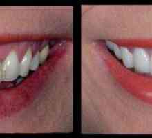 Keramičke krunice na prednjim zubima