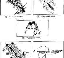 Enteroplexy: vrste. Metode spoj zid creva