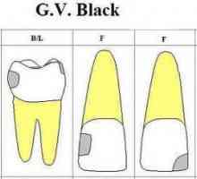 Klasifikacija Black šupljine: opis, stepen klase i liječenje