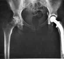Kada vam je potreban hip zglobova zamjena, a šta posljedice mogu biti u ovoj operaciji?