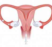 Kada se koristi intrauterine inseminacije?