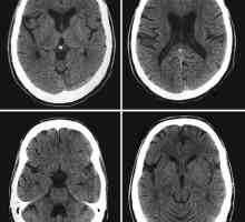 Kompjuterska tomografija mozga: pregled postupaka