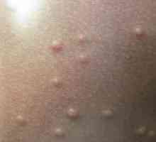 Molluscum contagiosum kod djece, liječenje kože