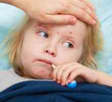 Ospice je dijete: Simptomi i tretman