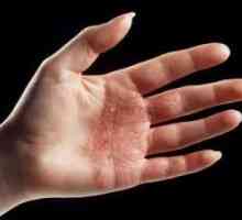 Sinister dermatitis na rukama: tretman