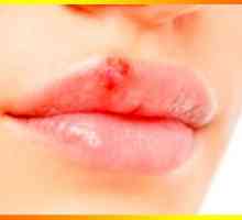 Sinister herpes, ili kako se postupa hladno na usnama