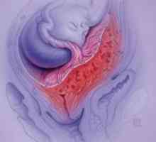 Marginalna placenta previa - opasnost za normalan tok trudnoće