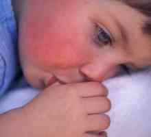 Crvena mrlja na obrazu bebe: uzroci, simptomi i karakteristike tretman