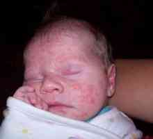 Crvena bubuljice na licu novorođenčeta
