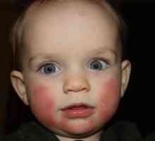 Crveni obrazi kod novorođenčadi: šta da radim? Crveni obrazi kod beba: uzroci, liječenje