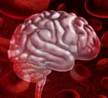 Krvarenje u mozgu: simptomi, liječenje, posljedice i prognoza