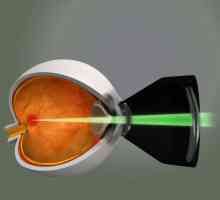 Laser koagulacije retine