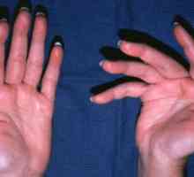 Tretman artritisa prstiju