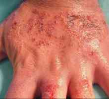 Tretman dermatitis na rukama dostupnih metoda