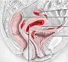 Tretman endometrioze narodnih lijekova. Komentari o biljni tretman