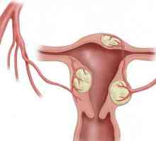 Liječenje mioma uterusa je efikasna folk pravnih lijekova: recenzije