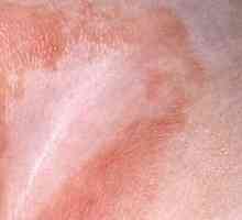 Tretman pelenskog osipa u preponi kod muškaraca: najefikasnijih načina