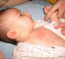 Potnichki tretman kod novorođenčadi