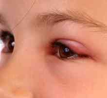 Mušica zalogaj tretman u oku na različite načine