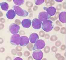 Leukemija: šta je to i da li postoji šansa za spas?