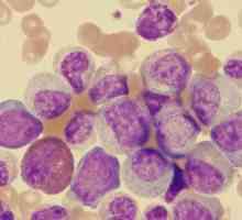 Leukemija - šta je to? Kako je dijagnoza ispravna?