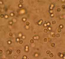 Leukociti u urinu povećana: uzroci i posljedice