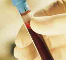 Bijelih krvnih stanica u mokraći djeteta povećane, ili prvi znaci infekcije