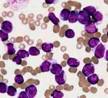 Leukemija - šta je to? Opis bolesti, uzroci, dijagnoza, prognoza
