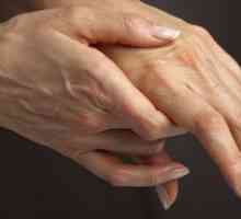 Medicina za zglobove - artritis lijek