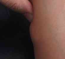 Lipom (masne tumor) na nogama: uzroci, simptomi i tretman