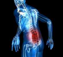 Lumbodynia: šta je to? Uzroci, simptomi i tretmani bol u leđima