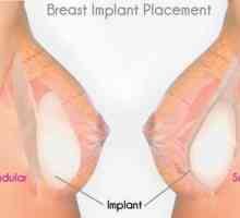 Dojke Implantati "pre" i "posle": rezultati različitih vrsta operacija