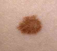 Melanom: Šta je to? Simptomi bolesti, prevenciju i liječenje melanoma
