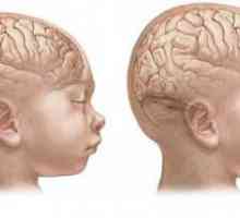 Mozak Mikrokefalija u djece: simptomi. Mikrocefaliju - a ...