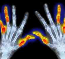ICD 10. Reumatoidni artritis: Simptomi i tretman