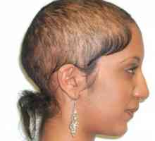 Da li postoji lek androgene alopecije? Uzroci gubitka kose. transplantacija kose