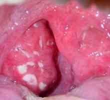 Koliko je opasno prisustvo kazeoznog tkiva utikača u grlu?