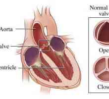 Aortne valvule 1, 2, 3 stupnja: znaci, simptomi, dijagnoza, liječenje