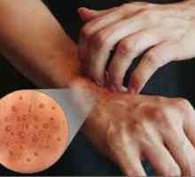 Atopijski dermatitis na rukama: etiologija, klinička liječenja