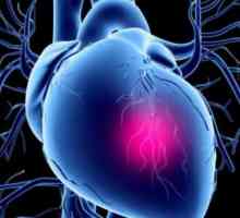 Hitna pomoć u kardiogenom šoku: algoritam akcija. ambulante za reanimaciju