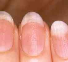 Jagged nokte: uzroci, liječenje