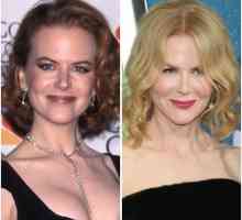 Nicole Kidman prije i nakon plastične (foto)