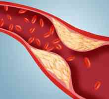 Norma holesterola u krvi muškaraca. Indikatori holesterola u krvi