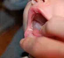 Šta znači bijele mrlje na jeziku u dojenčadi