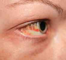 Šta upala krvnih žila u oku?