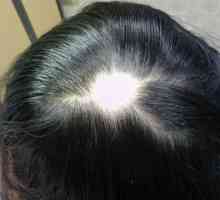 Gubitak kose u žena: Uzroci, liječenje. Znači za ćelavost za žene