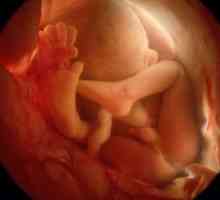 Entanglement pupčana vrpca oko vrata fetusa: kao što je to opasno?