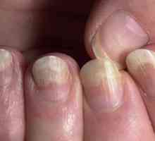Onichomicosis - što je to? Onichomicosis Nails: tretman kod kuće