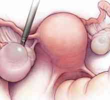 Operaciju uklanjanja jajnika ciste