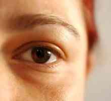 Oticanje gornjih očnih kapaka: kako se nositi s tim?